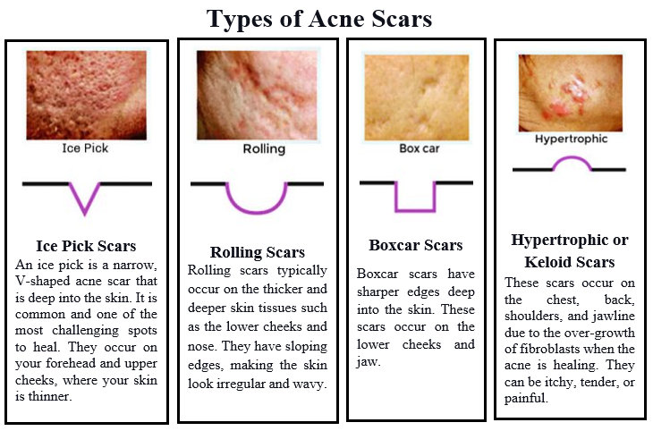 Types of Acne Scars