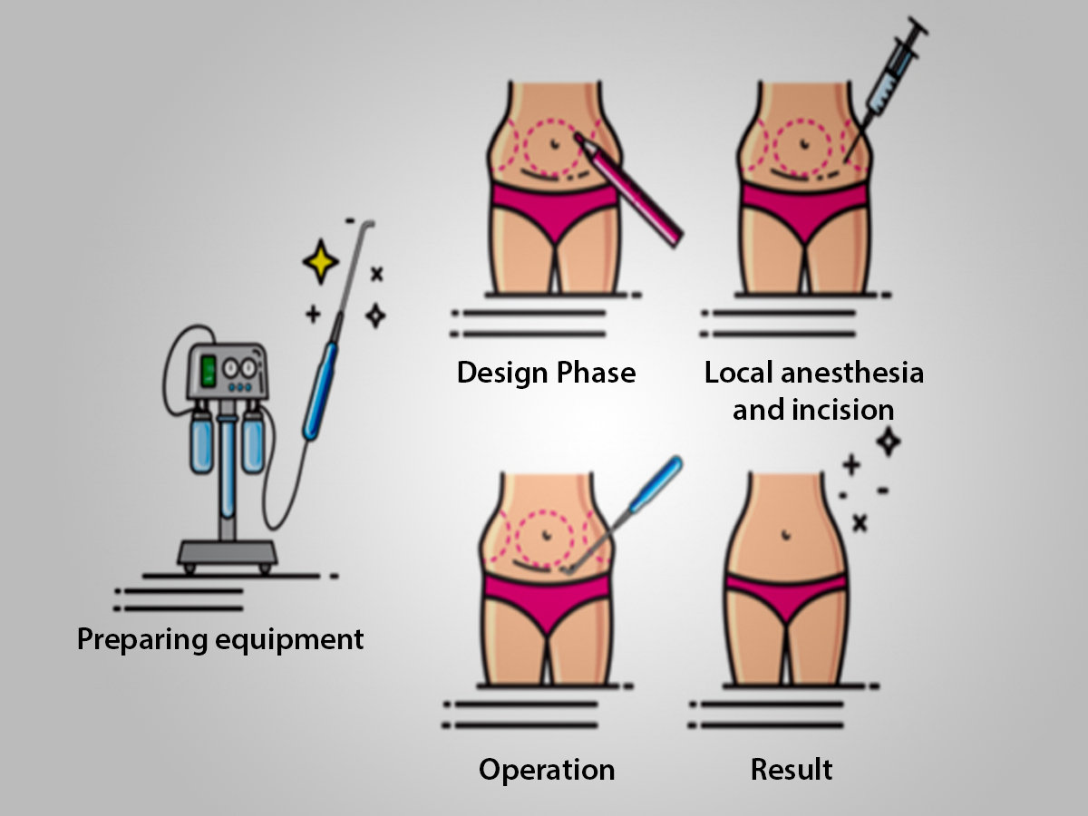 Liposuction in Jaipur