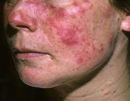 type of lupus