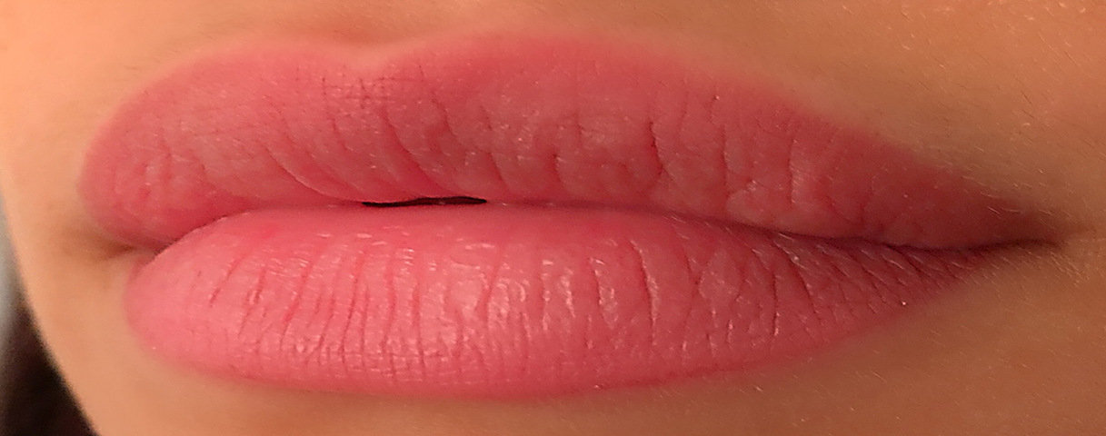 Lip Correction Surgery