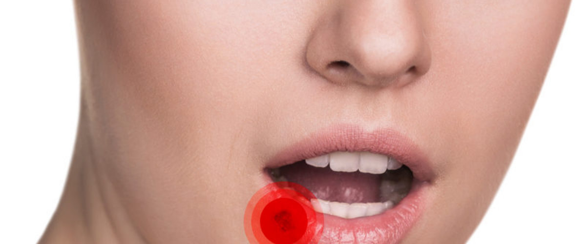 Homoeopathy Treatment for Cold sores