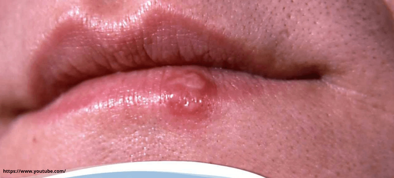 symptoms of cold sores