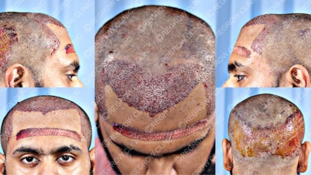 Grafts Placement Picture of Patient Grafts Placement Picture of Patient