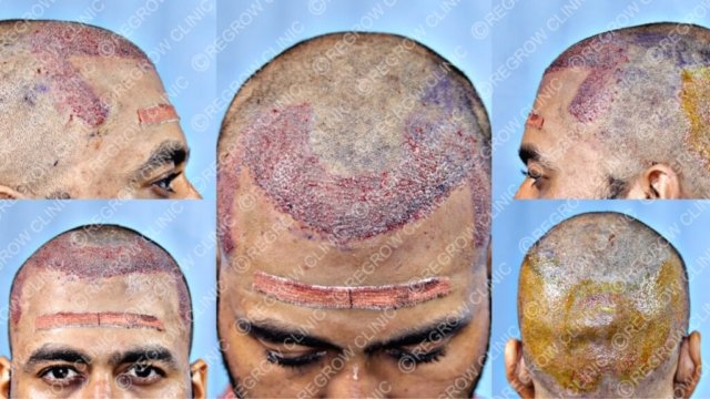 Grafts Placement Picture of Patient Grafts Placement Picture of Patient