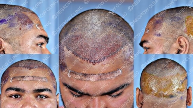 Grafts Placement Picture of Patient Grafts Placement Picture of Patient