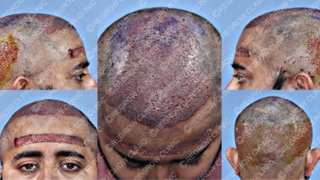 Grafts Placement Picture of Patient Grafts Placement Picture of Patient