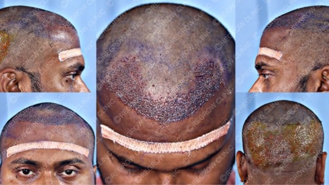 Grafts Placement Picture of Patient Grafts Placement Picture of Patient