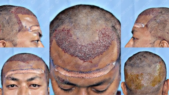 Grafts Placement Picture of Patient Grafts Placement Picture of Patient