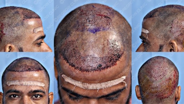 Grafts Placement Picture of Patient Grafts Placement Picture of Patient