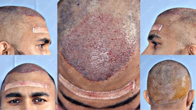 Grafts Placement Picture of Patient Grafts Placement Picture of Patient