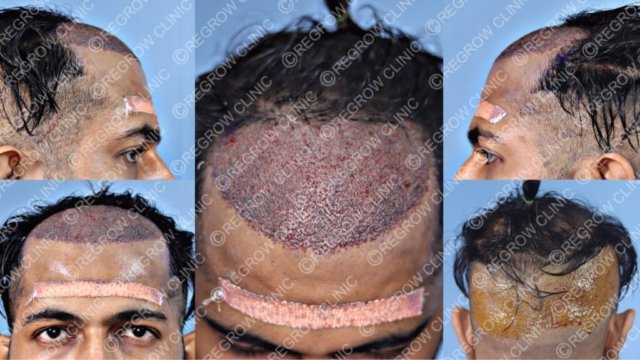 Grafts Placement Picture of Patient Grafts Placement Picture of Patient