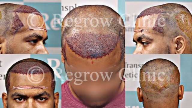 Grafts Placement Picture of Patient Grafts Placement Picture of Patient