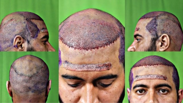 Grafts Placement Picture of Patient Grafts Placement Picture of Patient