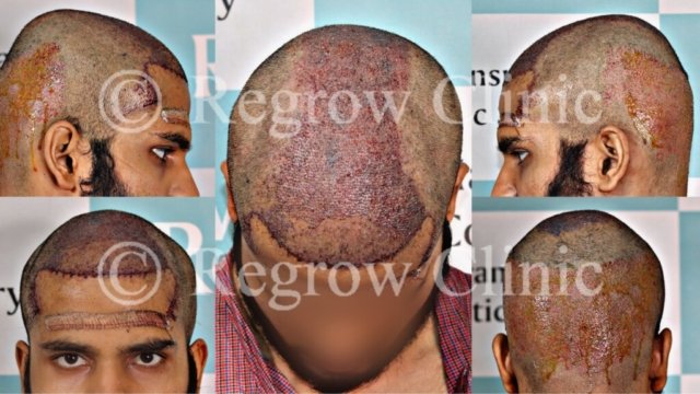 Grafts Placement Picture of Patient Grafts Placement Picture of Patient
