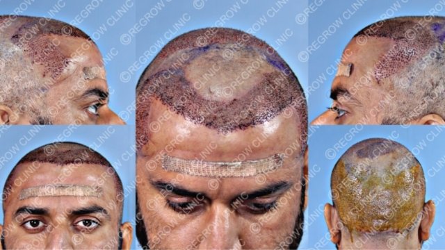 Grafts Placement Picture of Patient Grafts Placement Picture of Patient