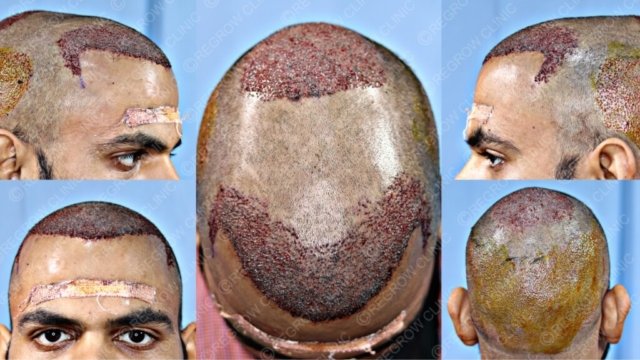 Grafts Placement Picture of Patient Grafts Placement Picture of Patient