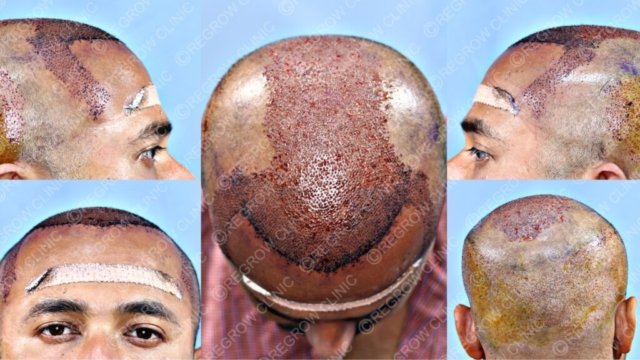 Grafts Placement Picture of Patient Grafts Placement Picture of Patient