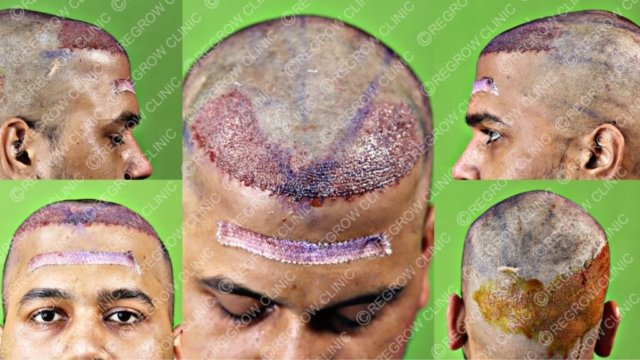 Grafts Placement Picture Grafts Placement Picture