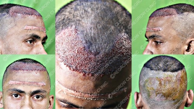 Grafts Placement Picture Grafts Placement Picture