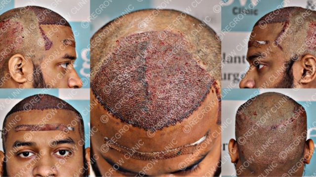 Grafts Placement Picture of Patient Grafts Placement Picture of Patient