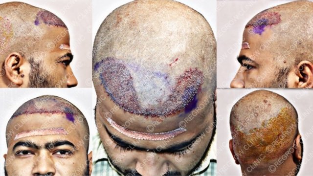 Grafts Placement Picture of Patient Grafts Placement Picture of Patient