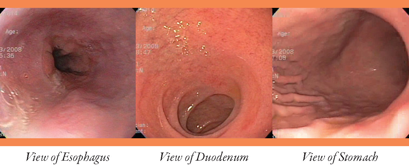 upperendoscopy_page_5