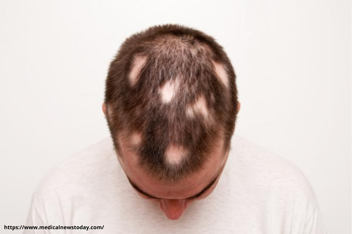 alopecia areata