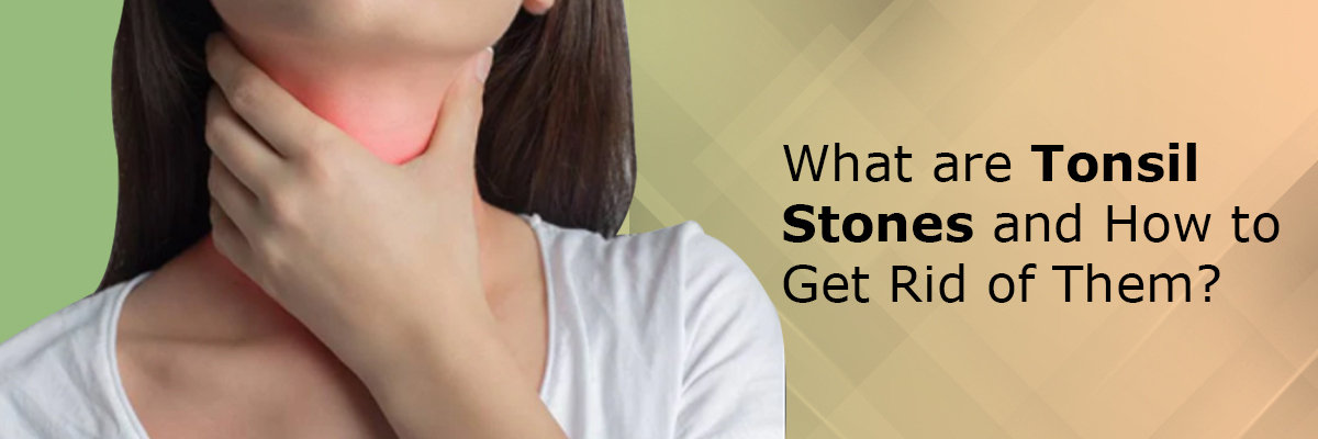 What are tonsil stones and how to get rid of them? What are tonsil stones and how to get rid of them?