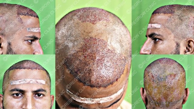 Grafts Placement Picture Grafts Placement Picture