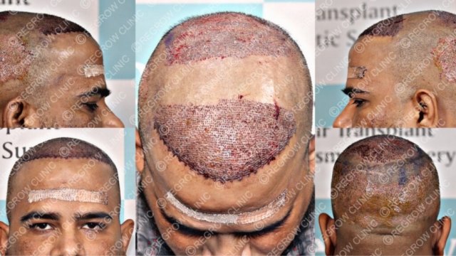 Grafts Placement Picture of Patient Grafts Placement Picture of Patient