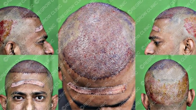 Grafts Placement Picture of Patient Grafts Placement Picture of Patient