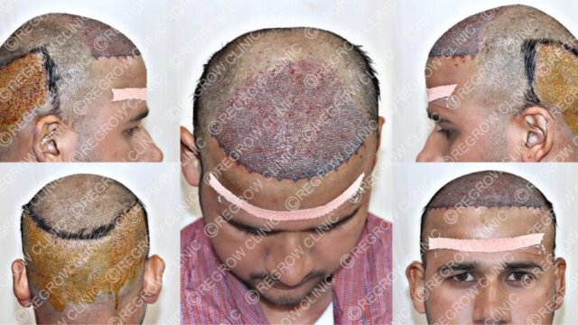 Grafts Placement Picture of Patient Grafts Placement Picture of Patient
