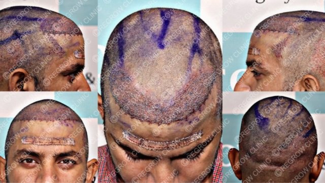Grafts Placement Picture of Patient Grafts Placement Picture of Patient