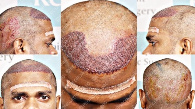 Grafts Placement Picture of Patient Grafts Placement Picture of Patient