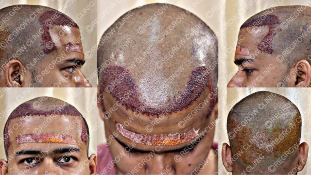 Grafts Placement Picture of Patient Grafts Placement Picture of Patient