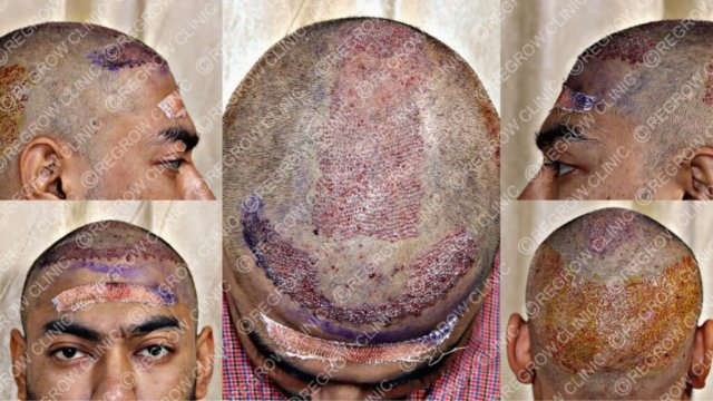 Grafts Placement Picture of Patient Grafts Placement Picture of Patient