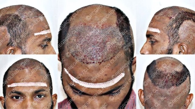 Grafts Placement Picture of Patient Grafts Placement Picture of Patient