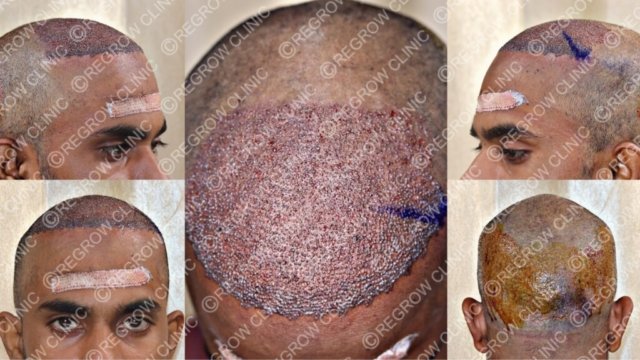 Grafts Placement Picture of Patient Grafts Placement Picture of Patient
