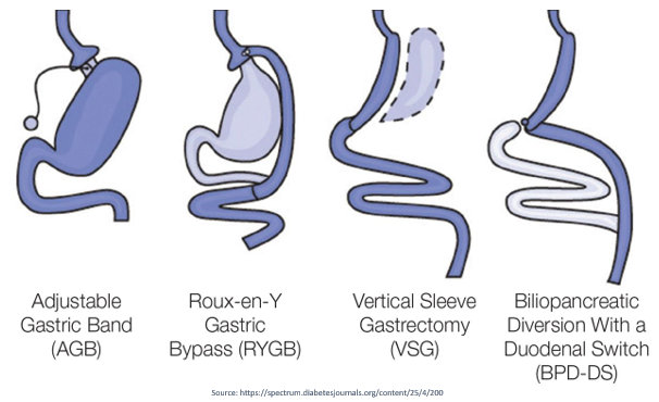 Bariatric Surgery in Kilpauk