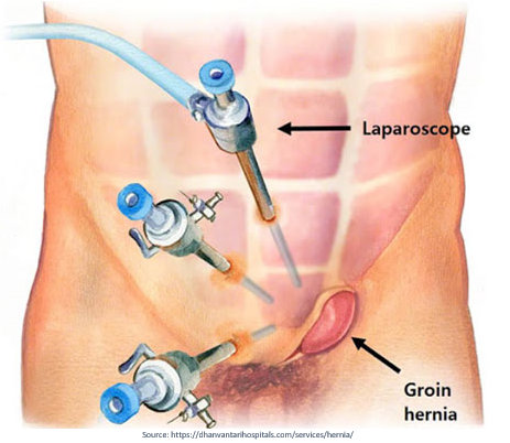 Laparoscopic Hernia Surgery in Kilpauk