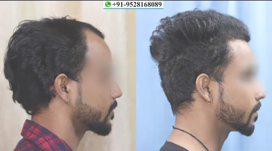 Before - After Images of the patient