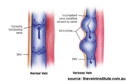 Varicose Veins