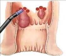 Laser piles treatment