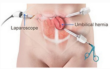 Laparoscopic hernia surgery