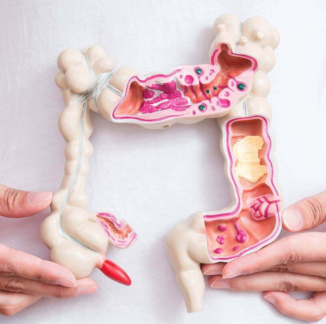 When do you need colorectal surgery