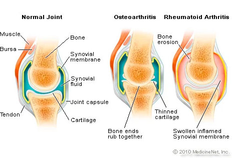 causes of arthritis