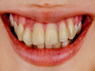 Tooth staining