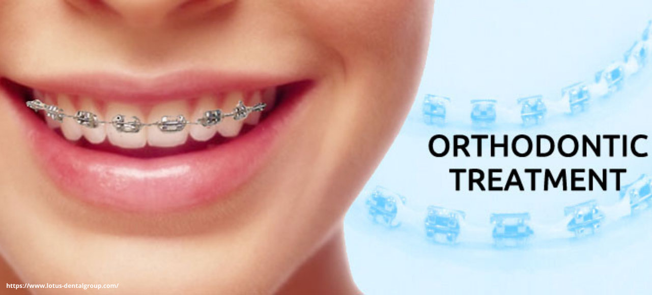 Orthodontic treatment Orthodontic treatment