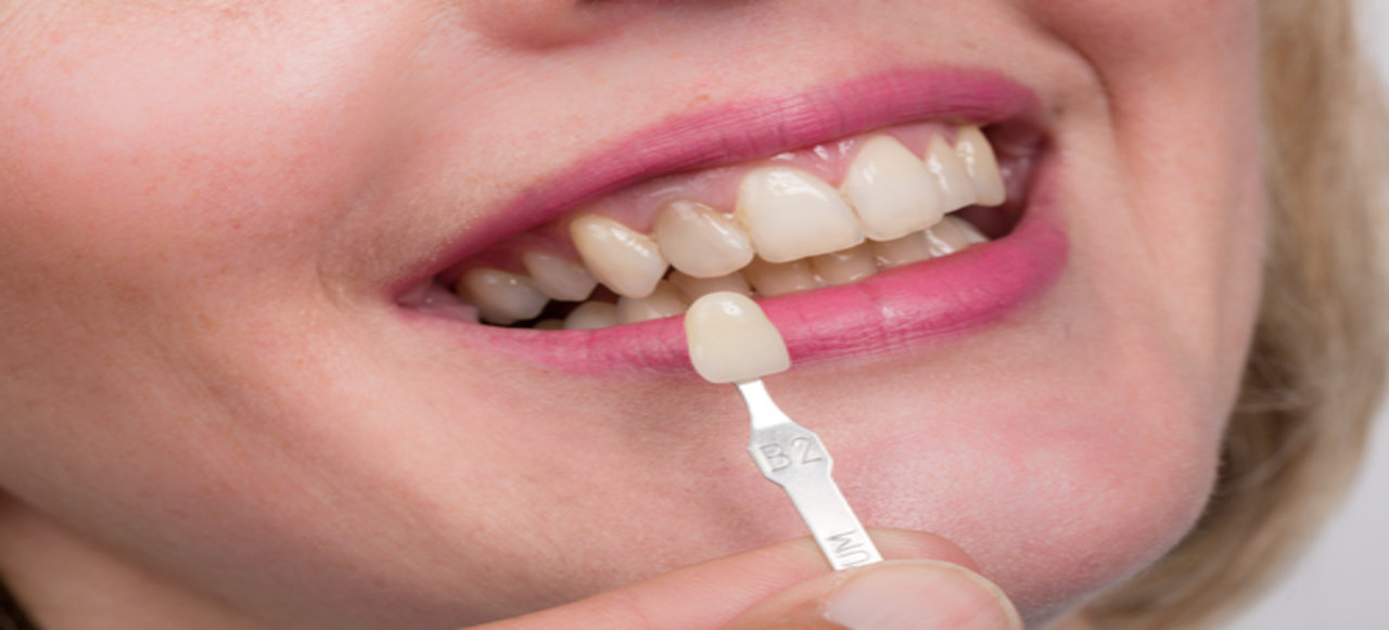 dental crown dental crown