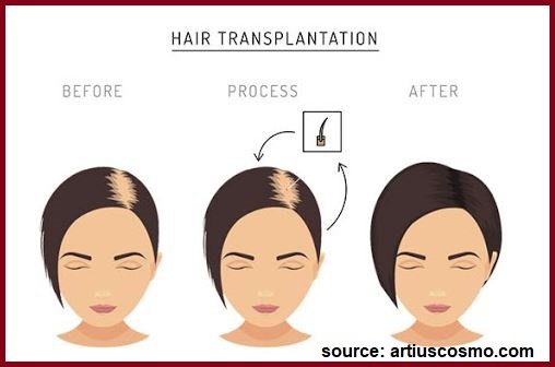 hair transplant for women process